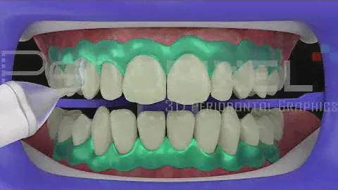 Blanqueamiento Dental con lámpara Philips Zoom - PerioPixel